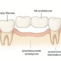 Jak wybrać między implantami, mostami a protezami: co musisz wiedzieć